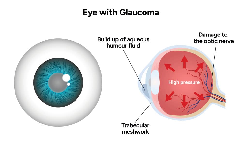 Chart illustrating a healthy eye vs one with glaucoma and damage to the optic nerve